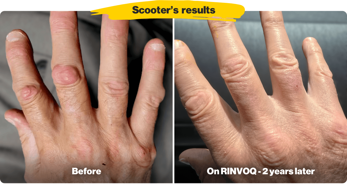 RA hands showing improvement, before and after