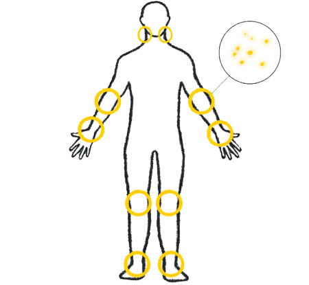 Body outline with skin inflammation highlighted