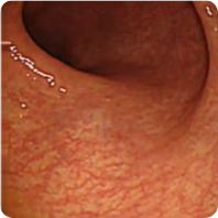 Patient 1’s colon after 1 year on Rinvoq