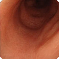 Patient 2’s colon after 1 year on Rinvoq