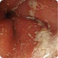 Patient 1’s colon before Rinvoq