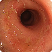 Patient 2’s colon before Rinvoq