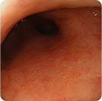 Patient 2’s colon after 8 weeks on Rinvoq