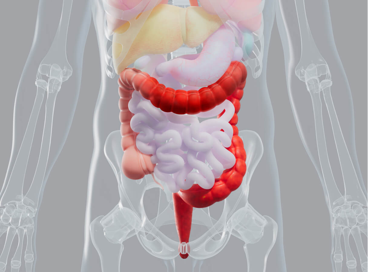 Diagram of a body with unhealthy colon lining