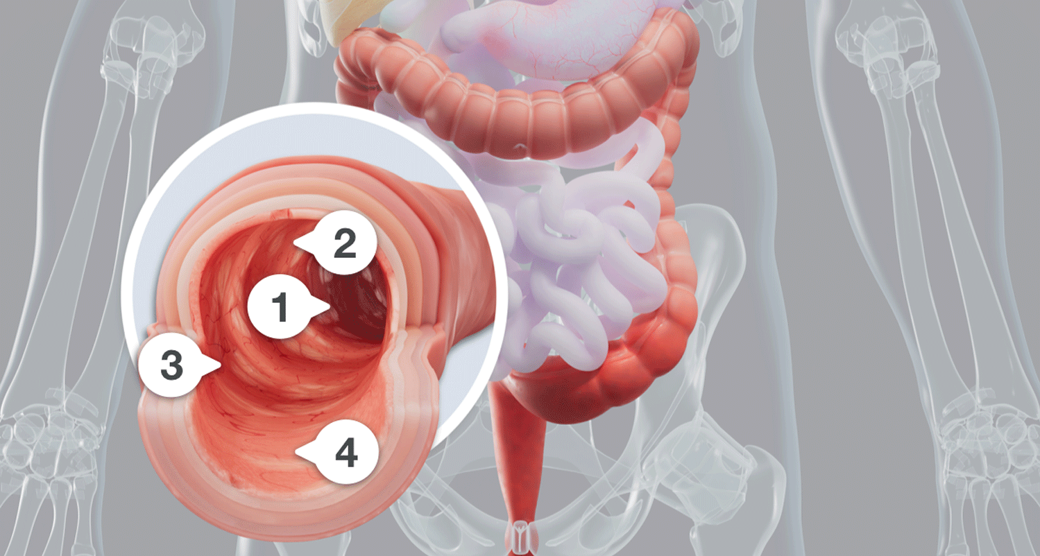 Illustration showing visible colon lining repair