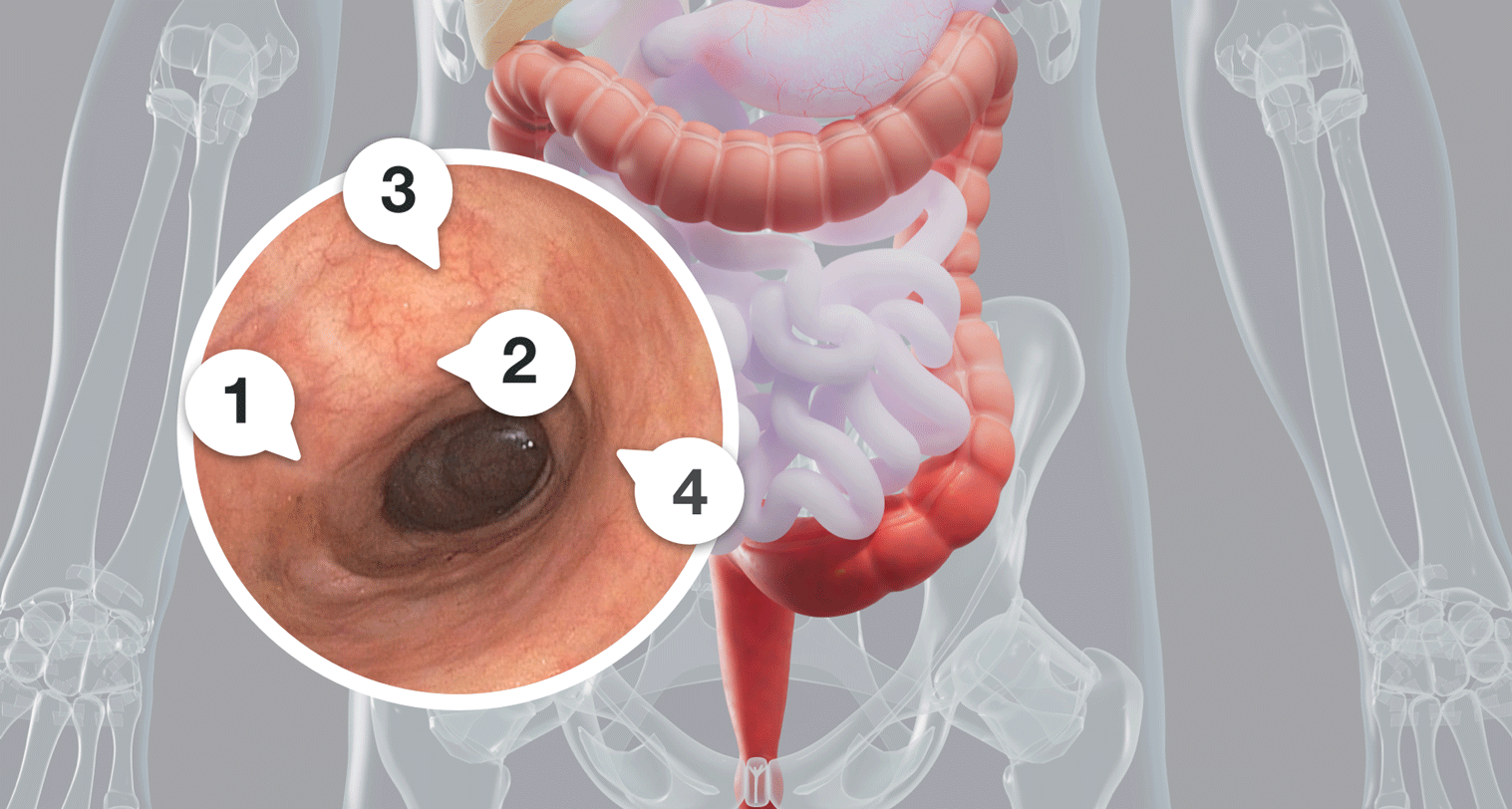 Endoscopy image showing visible colon lining repair