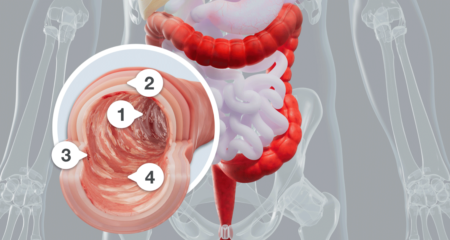 Illustration of damage to the colon lining caused by inflammation