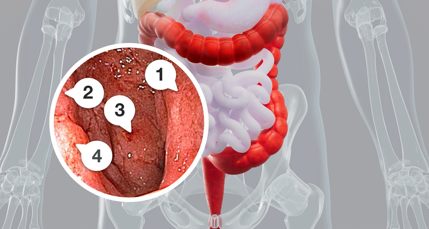 Endoscopy image showing damage to the colon lining caused by inflammation