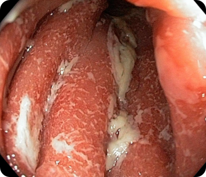 A colon lining visibly damaged by inflammation seen by endoscopy